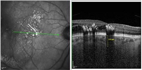 macular choroidal thickness measurement|choroidal thickness in women.